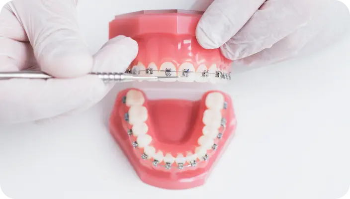 ワイヤーを使った本格矯正